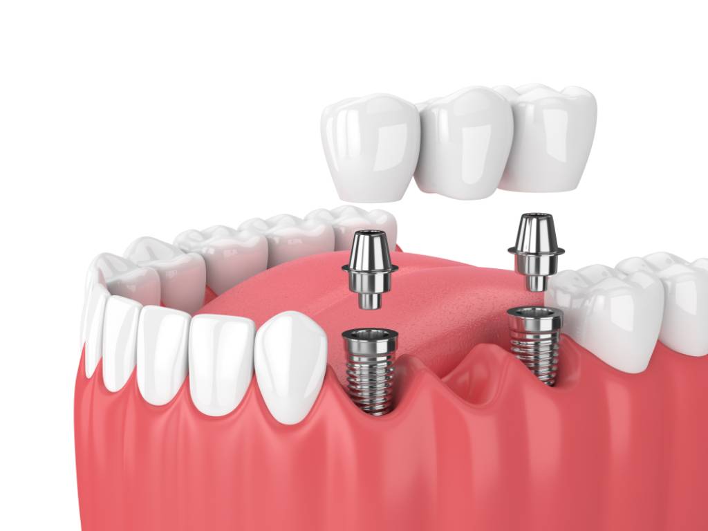 3D rendering of jaw for dental implants