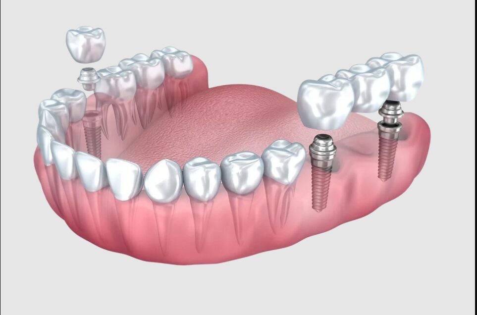 dental implants