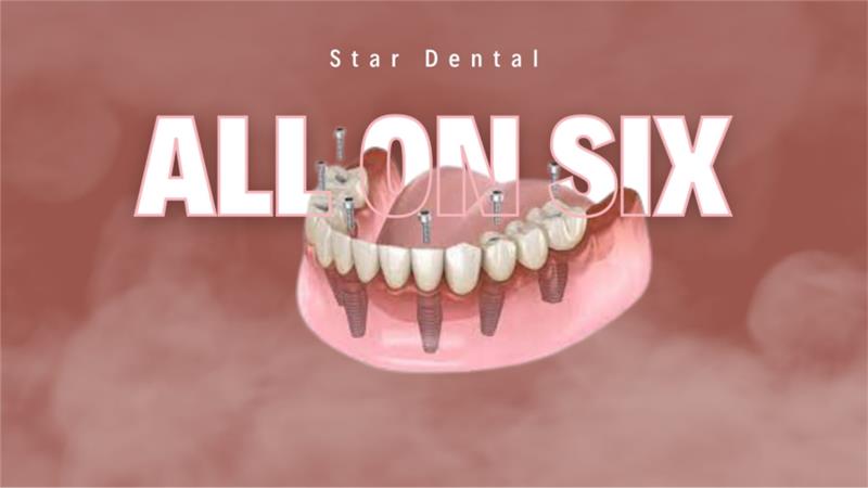 Star Dental | Dental Implants