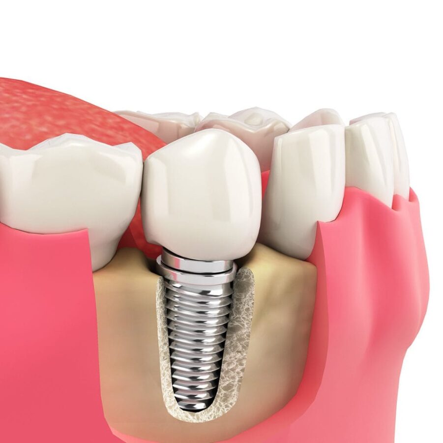 Star Dental | Dental Implants